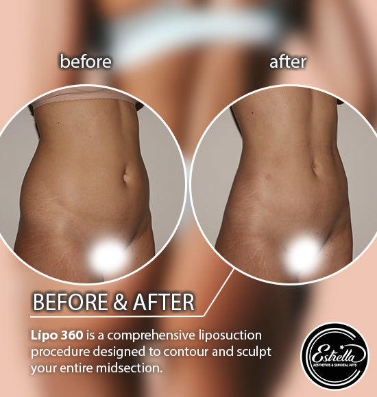 Lipo 360 Torso + FREE Fat Transfer!