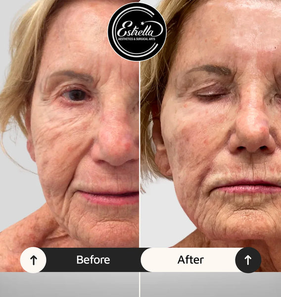 💐 Timeless Beauty Starts This May with Bellafill® 💖 | Estrella ...
