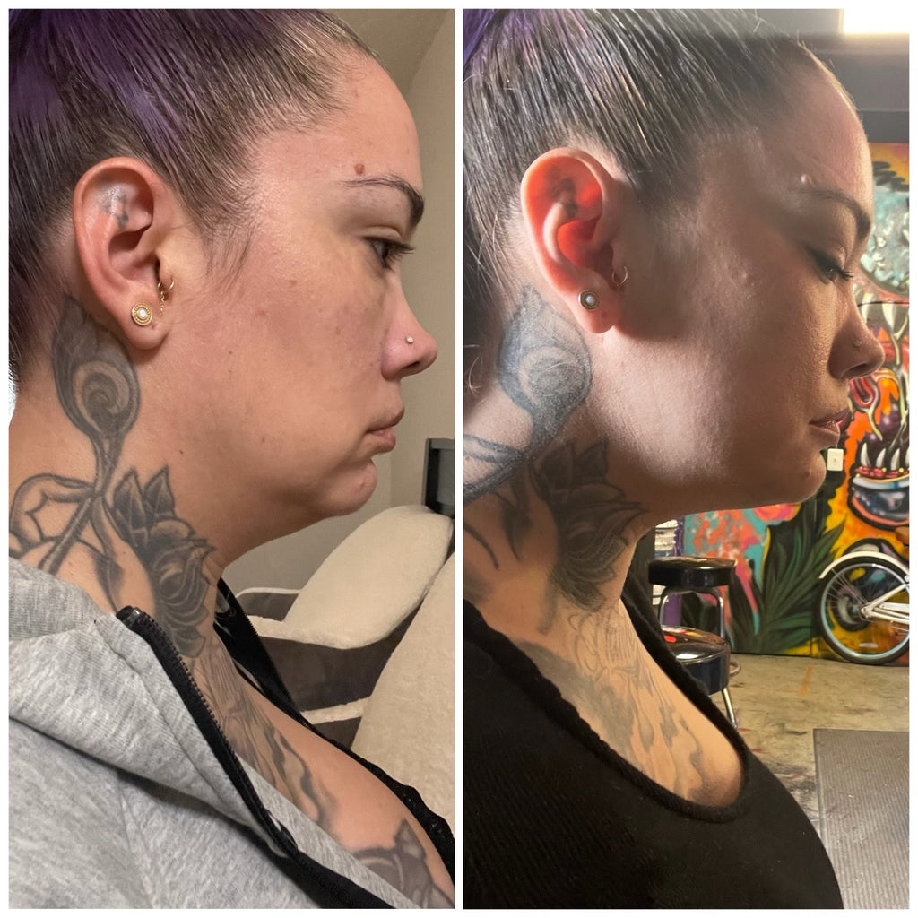 Sculpt a Sharper, More Defined Jawline With Tox ✨🎄