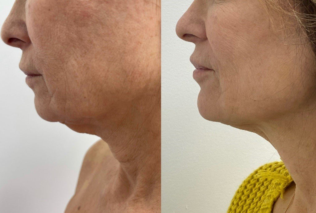 Define Your Jawline with Lipo & Renuvion to Under the Chin