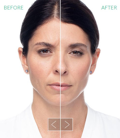 Erase Fine Lines and Wrinkles with Dysport®