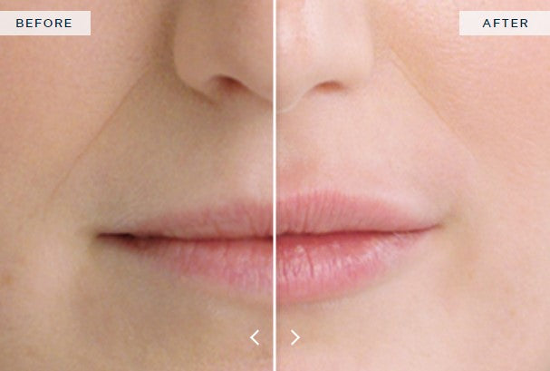 Get the Lips You’ve Always Wanted with Restylane Kysse