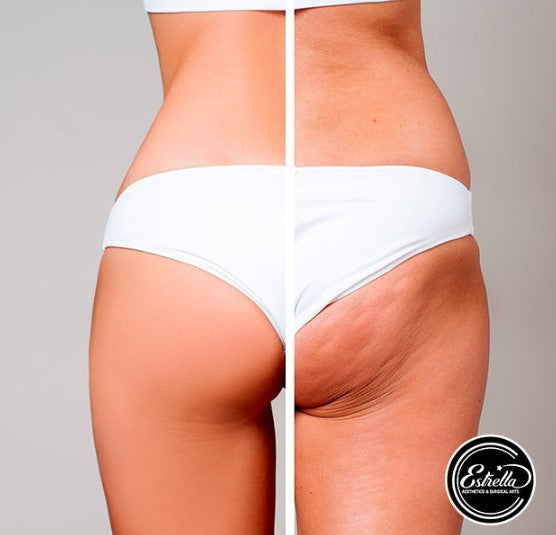 Get Bikini Ready & Smooth out Cellulite with Velashape