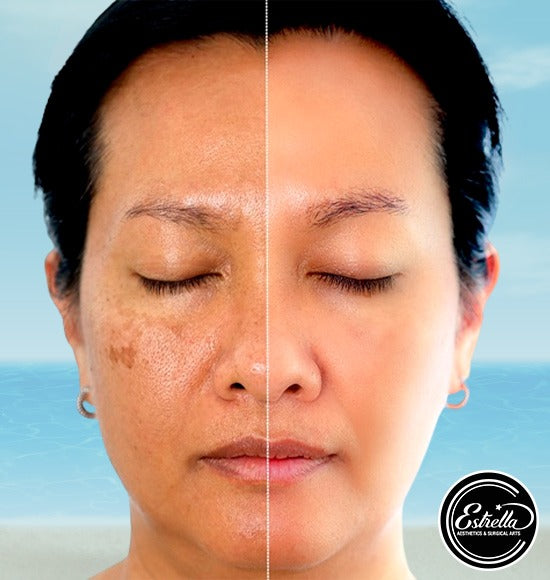 Erase Your Melasma today