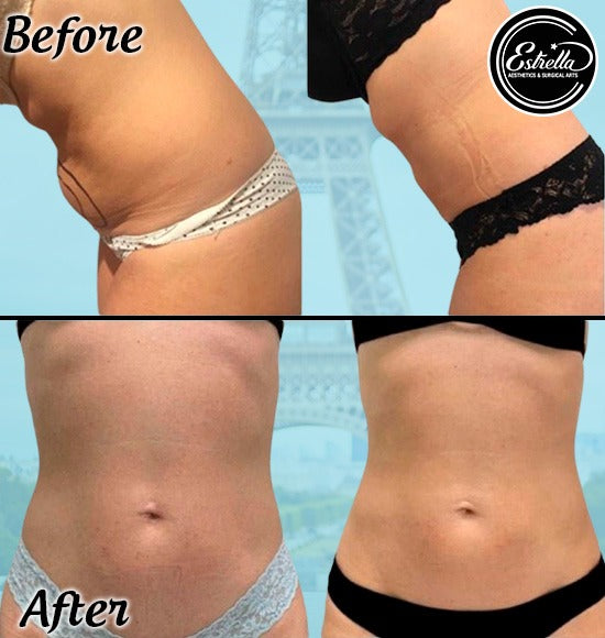 Ultimate Body Sculpting with Fotona Laser One Area