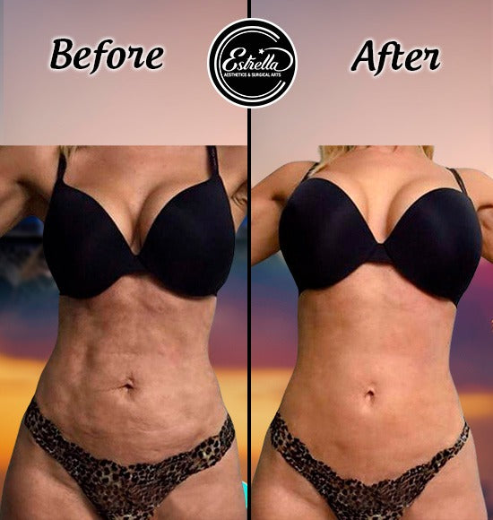 Ultimate Body Sculpting with Fotona Laser One Area