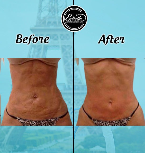 Ultimate Body Sculpting with Fotona Laser One Area