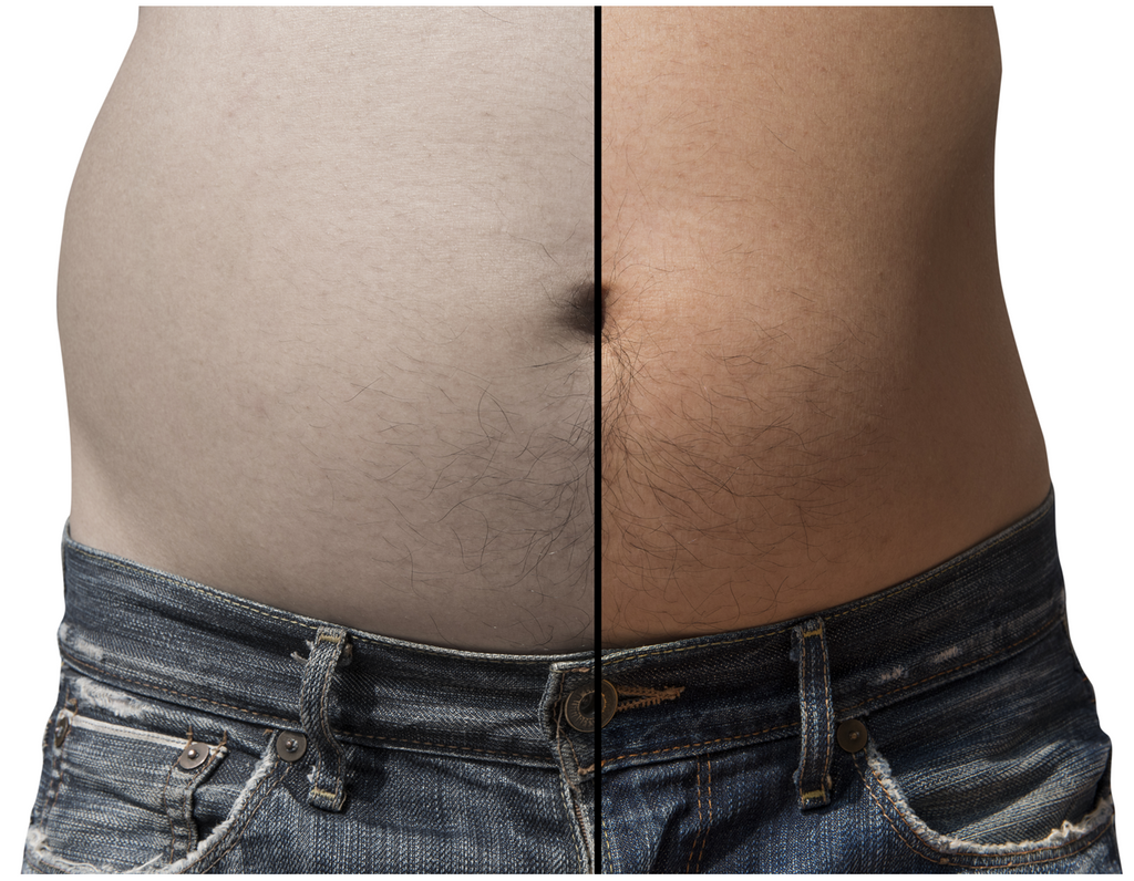 🕸️ Scare Away Stubborn Fat with Lipo—One Area! 🕸️