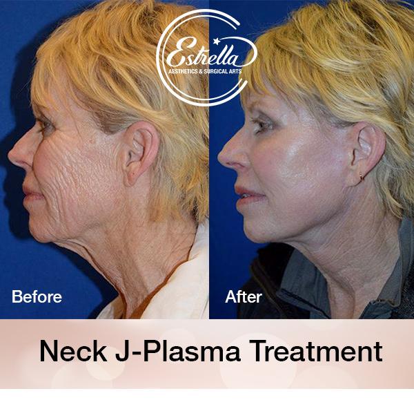 Define Your Jawline with Lipo & Renuvion to Under the Chin