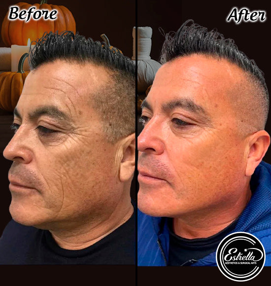 Custom Pumpkin Hydrafacial MD + Chemical Peel