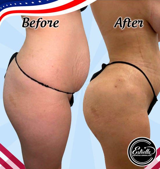 ✨Mini In-Office Lipo & Booty Fat Transfer