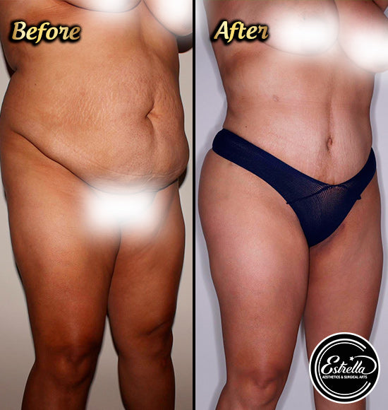 ✨ Sculpt Your Dream Body with Lipo 360 ✨