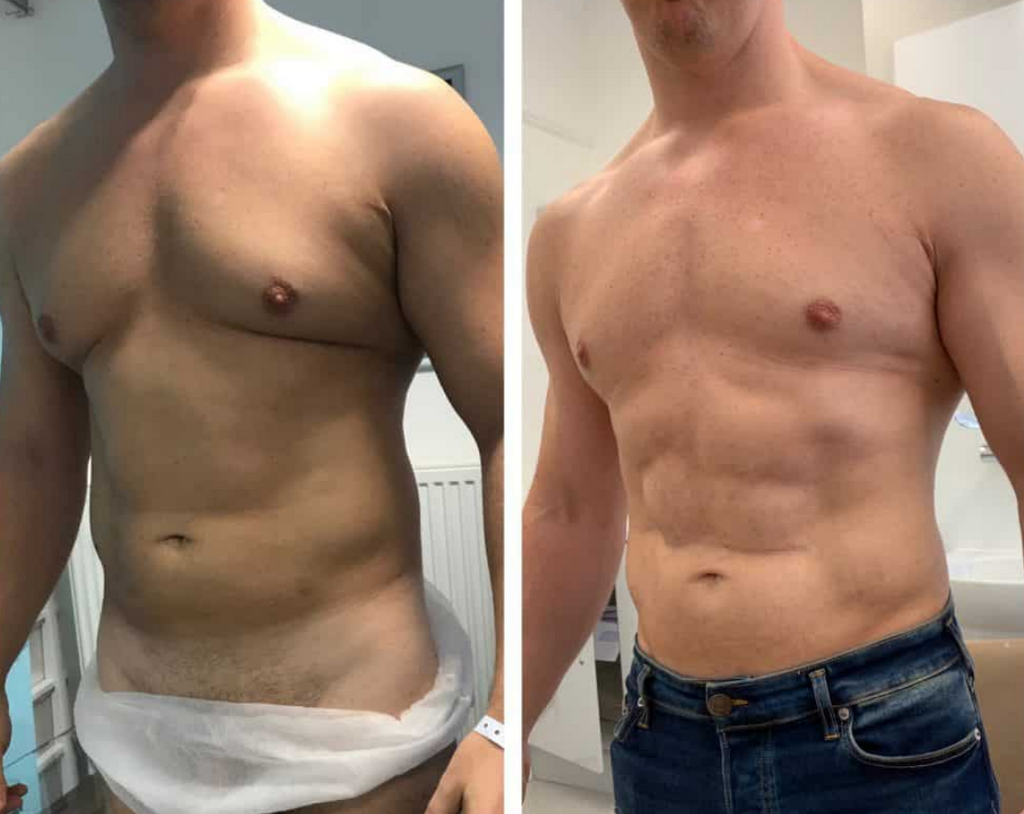 🕸️ Scare Away Stubborn Fat with Lipo—One Area! 🕸️