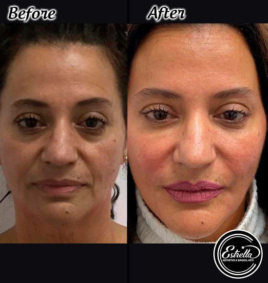 Restore Volume and Soften Wrinkles with Versa