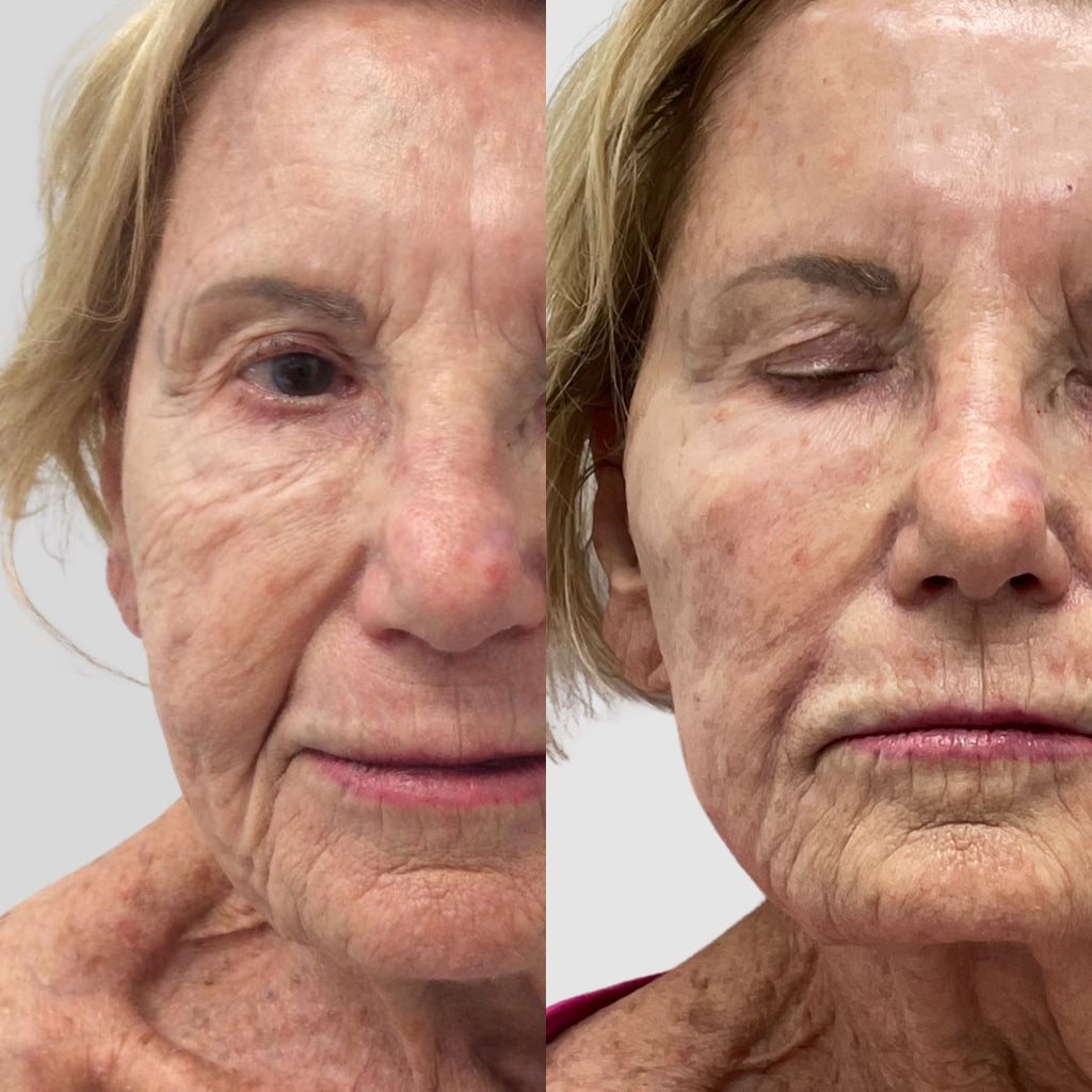 Bellafill® The Only 5 Year Filler