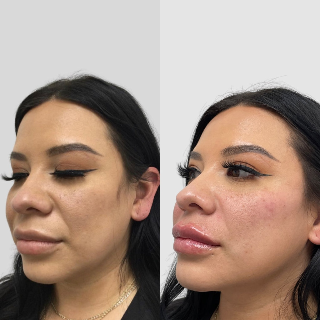 💋 Pre-Black Friday Deal: Vamp Your Lips with Revanesse® Versa!