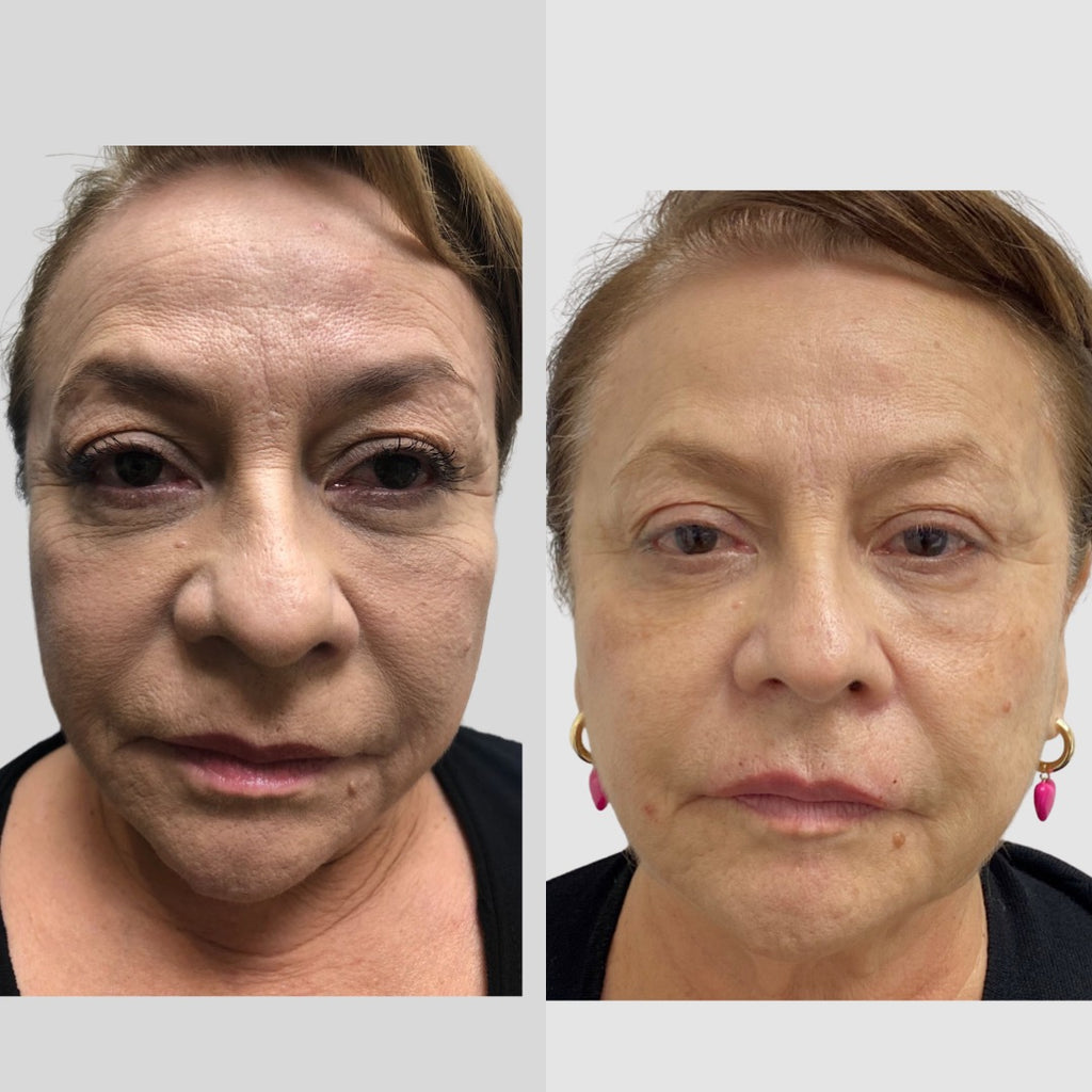 💋 Pre-Black Friday Deal: Vamp Your Lips with Revanesse® Versa!