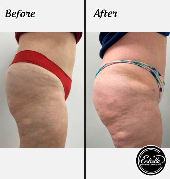 ✨ Sleigh This Holiday Season with a Booty Fat Transfer with Summer! ✨