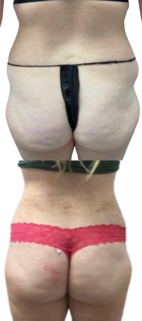 ✨ Sleigh This Holiday Season with a Booty Fat Transfer with Summer! ✨