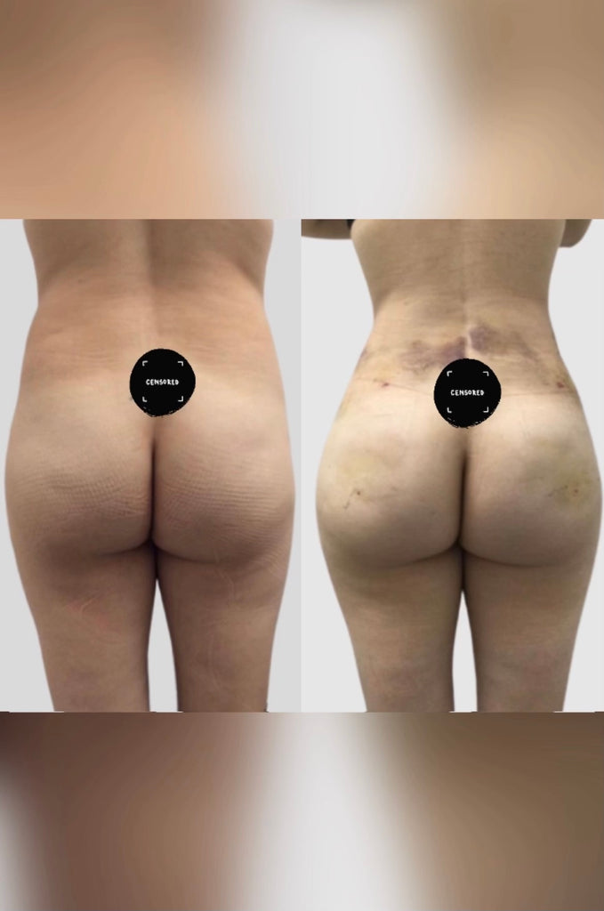 ✨Mini In-Office Lipo & Booty Fat Transfer