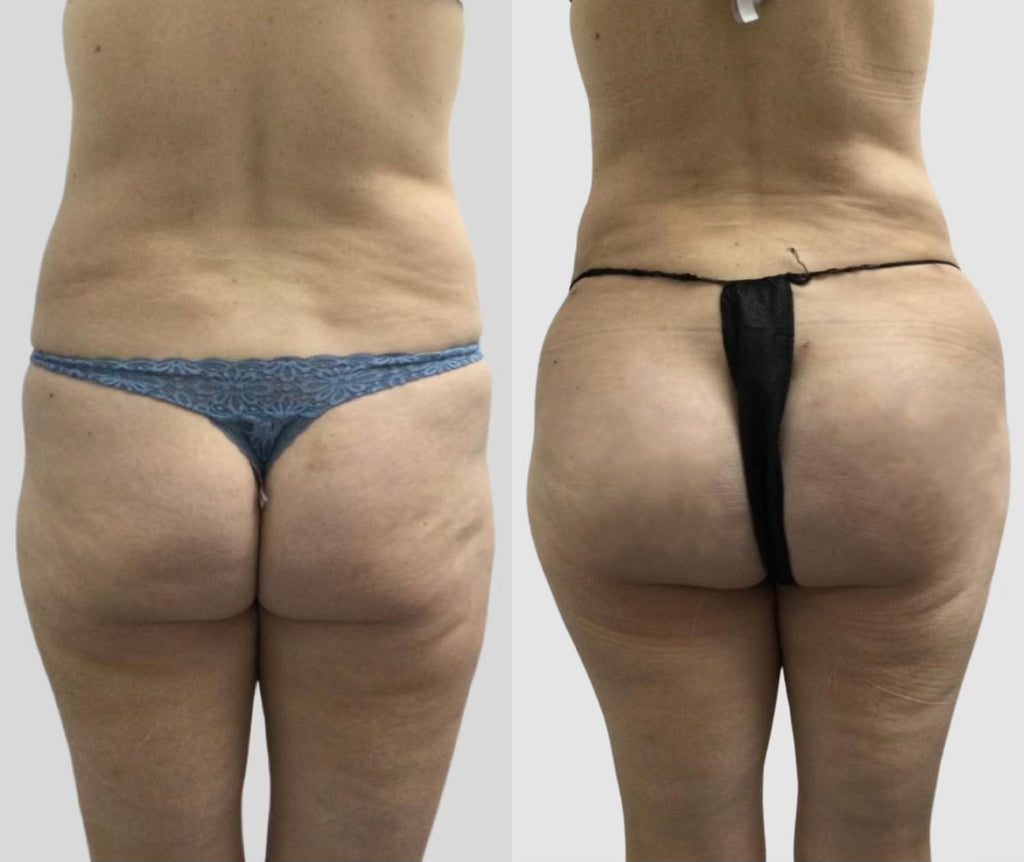 ✨ Sleigh This Holiday Season with a Booty Fat Transfer with Summer! ✨