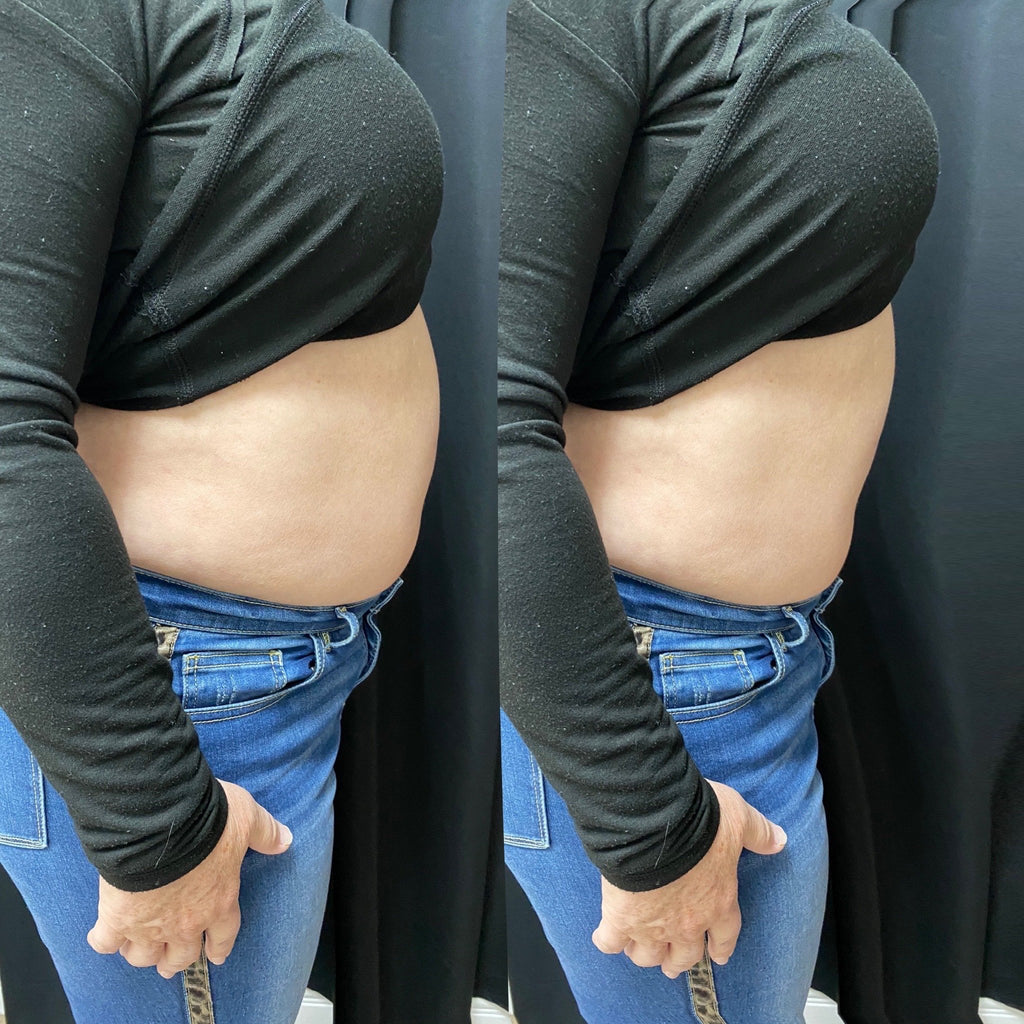 Kiss the Fat Goodbye with Kybella 💉