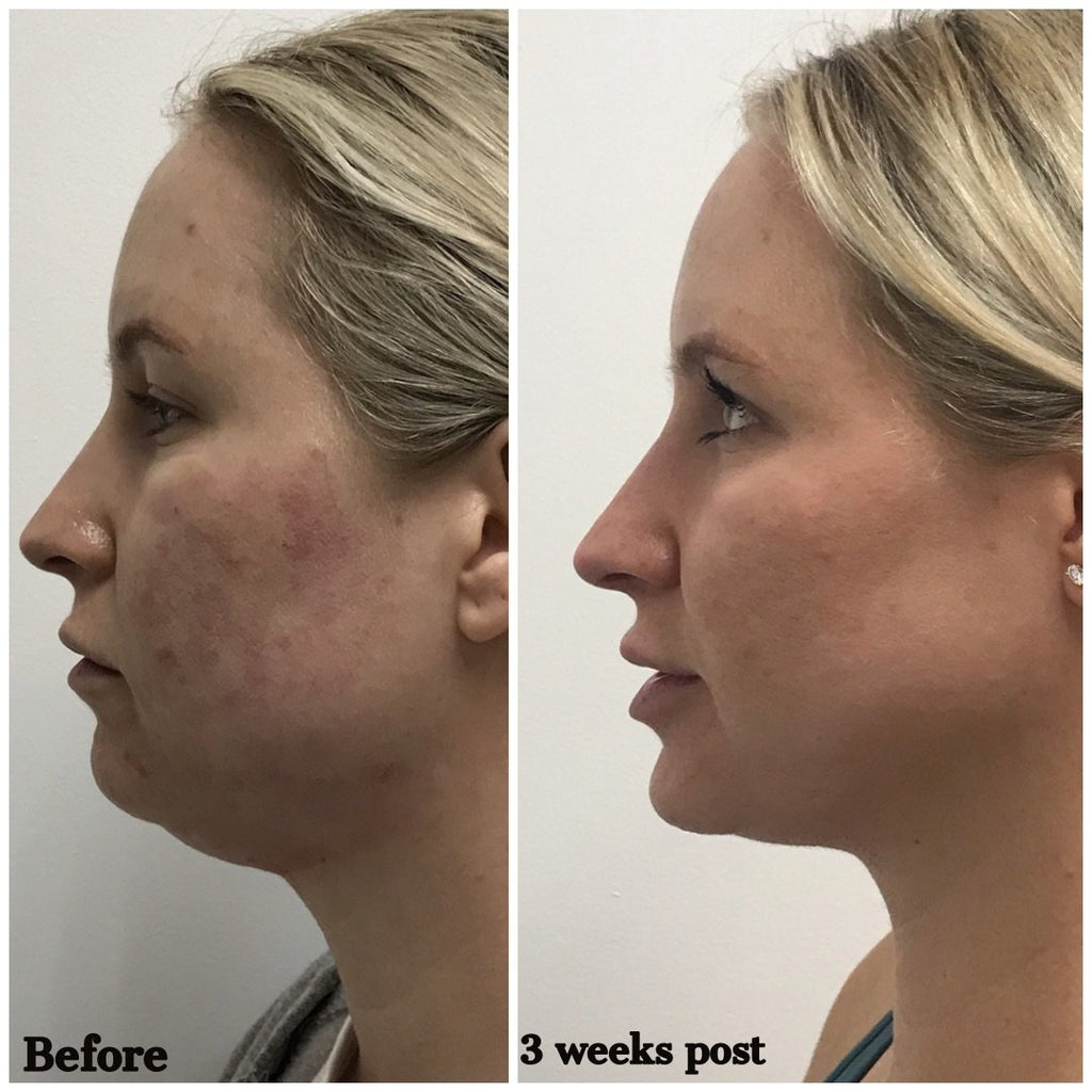 Kiss the Fat Goodbye with Kybella 💉