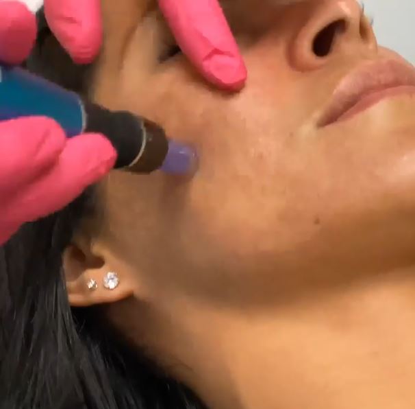 Rejuvenate Your Skin With A PRP Facial