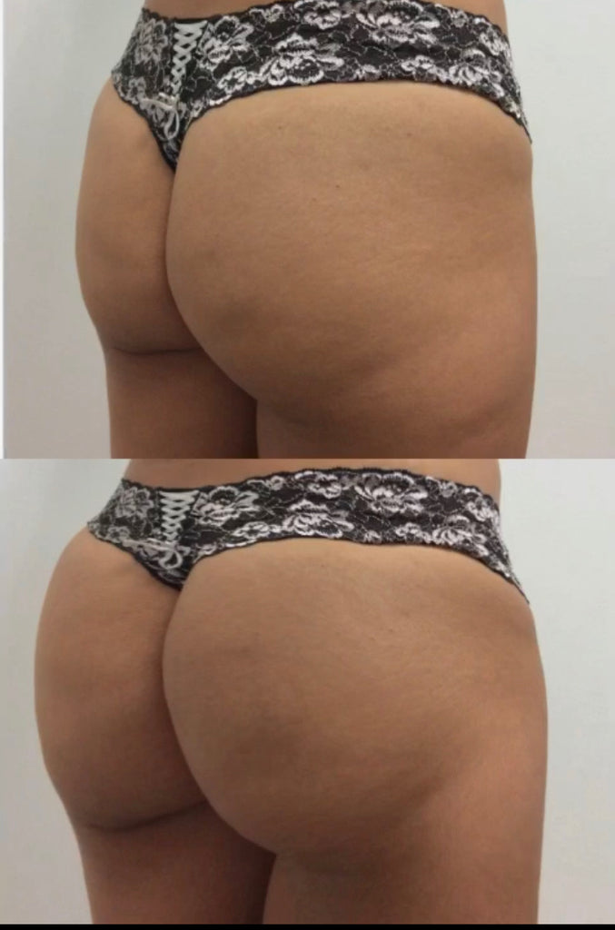 🖤 Pre-Black Friday Deal: Booty Lift, Plump & Rejuvenate with Radiesse®