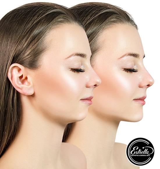 Kiss the Fat Goodbye with Kybella 💉
