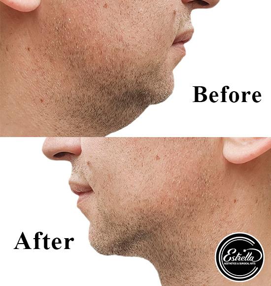 Kiss the Fat Goodbye with Kybella 💉