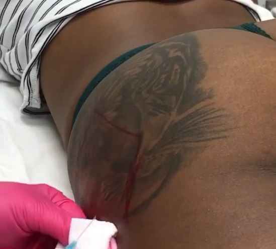 🖤 Pre-Black Friday Deal: Booty Lift, Plump & Rejuvenate with Radiesse®